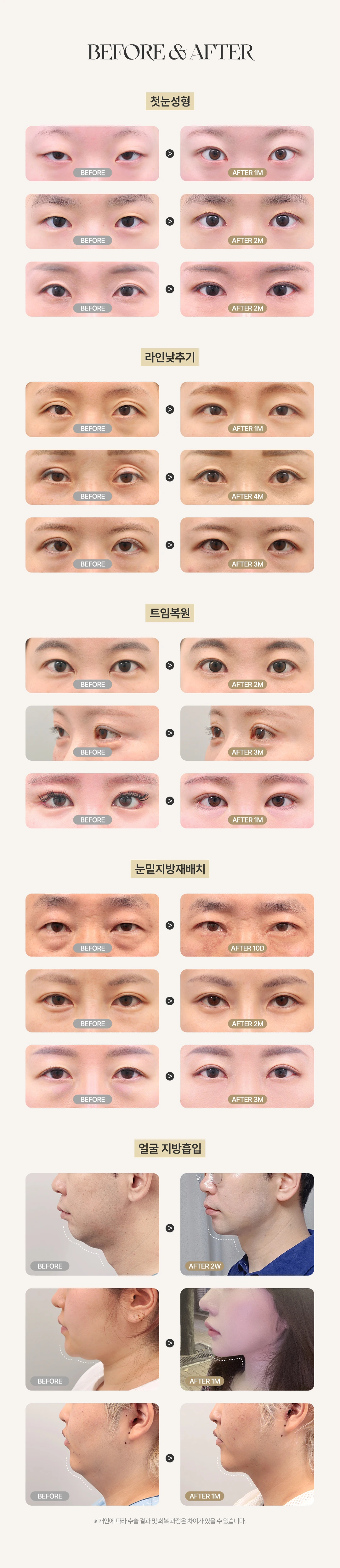 첫눈성형, 라인낮추기, 트임복원, 눈밑지방재배치, 얼굴 지방흡입 전후 사례. 개인에 따라 수술 결과 및 회복 과정은 차이가 있을 수 있습니다